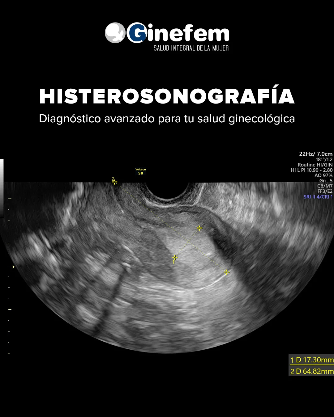 Histerosonosalpingografia