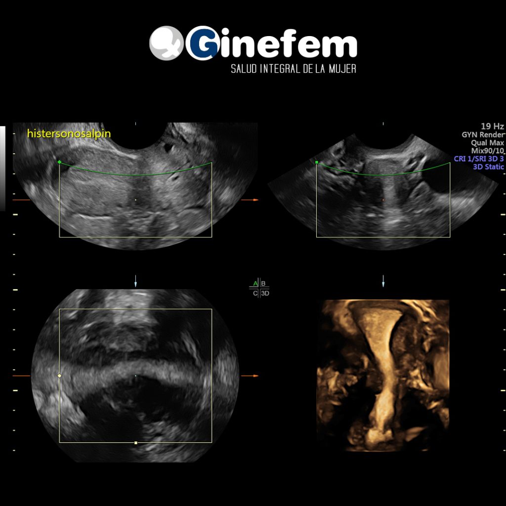 Histerosonosalpingografía